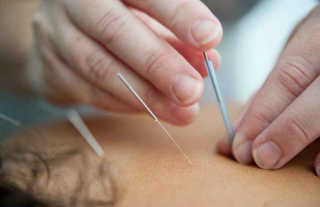 Acupuncture service