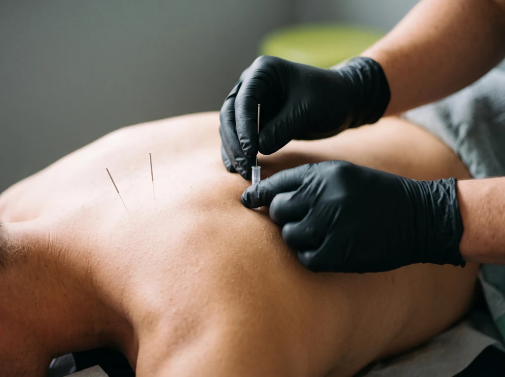 Иглотерапия (dry needling) в мускулите на рамото